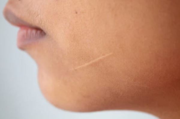 Как избавиться от шрамов — самый современный способ